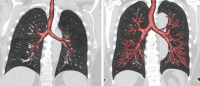 lungs with different degrees of dysanapsis